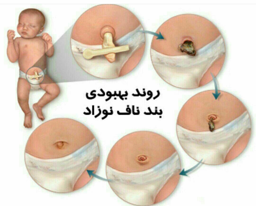 پرتو نوزاد پارس | روند بهبودی بند ناف نوزاد