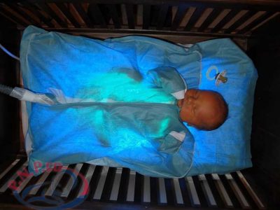 پرتو نوزاد پارس | درمان زردی بدون چشم بند